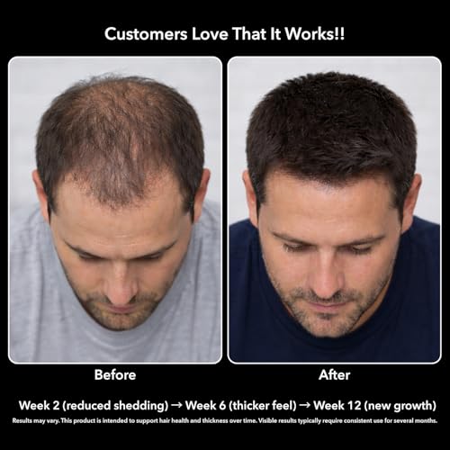 DHT Blocker for Men with Biotin 10000mcg Per Serving, 30 Servings