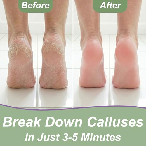 Foot Callus Remover Gel & File, Extra Strength Callus Remover for Feet 4 oz 4 oz Gel Steel File