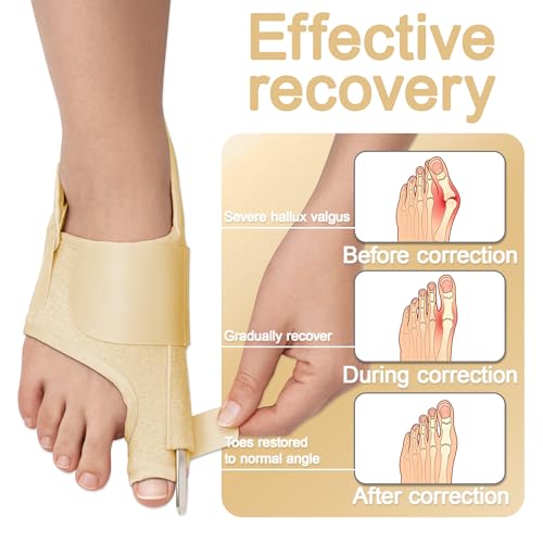 SPRING SEAON 2-Pack Bunion Corrector Adjustable Toe Splint Day/Night Beige