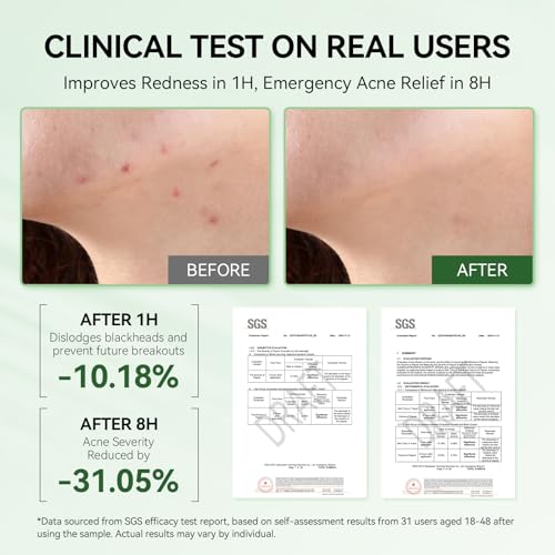 LANBENA 2% Salicylic Acid Acne Spot Treatment Drying Lotion, 0.42 Fl Oz 0.42Fl Oz-18% ZINC OXIDE Acne Dryig Lotion