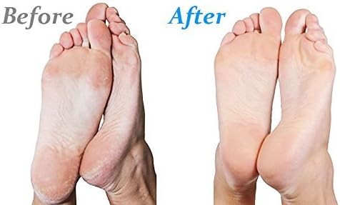 Emjoi Micro-Pedi 3D POWER Callus Remover with Xtreme Coarse Soft & Flexible Roller (Most Powerful & Corded)