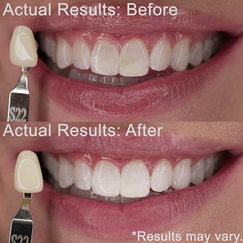 EZZI Teeth Whitening Kit | Fast Whitener Gel 44% Carbamide Peroxide | for Discolored, Yellow, Brown, Black, Coffee, Smoking, Intrinisic Deep Stains