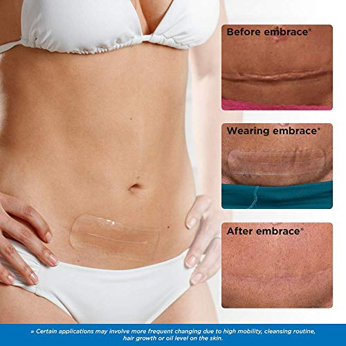 Embrace Active Scar Defense for New Scars, FDA-Cleared Medical-Grade Silicone Scar Sheets for Hypertrophic & Keloid Scar Treatment, 4.7 Inch, Large, 30-Day Supply Large, 4.7in (30 Day Supply)