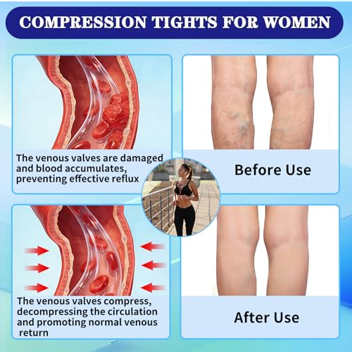 Medical Compression Leggings 20-30mmHg Graduated Support Tights X-Large Footless/Black+beige