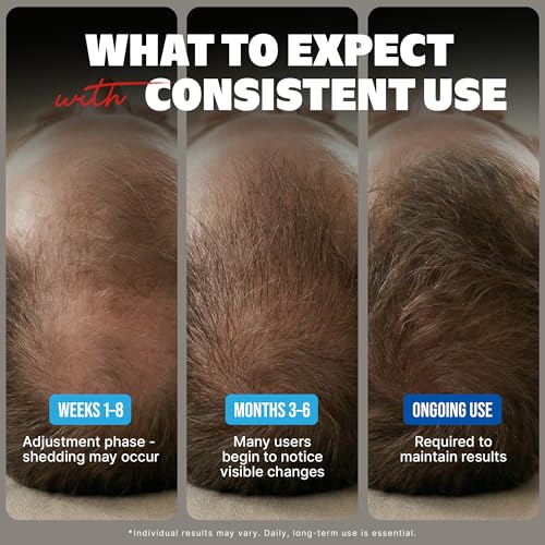 Kirkland Minoxidil for Men Liquid, Extra Strength Hair Regrowth Treatment 5%, 6 Months Supply - Upgraded Dropper Applicator and Bonus Free Guide Included