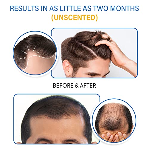 5% Minoxidil Foam for Men and Women: Hair Regrowth, Fast-Absorbing Lightweight Minoxidil Treatment for Thinning Hair, Receding Hairline & Balding, Non-Greasy Unscented Hair Growth Foam Clear 4.14 Count (Pack of 1)