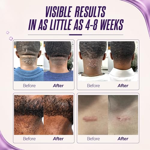 ABERA Kelo Scar Cream – Scar Removal Cream for AKN Bump Treatment, Razor Bump Treatment for Men & Keloid Bump Removal with Purple Onion & Black Reishi 1 Box