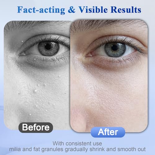 Milia Remover for Face & Eyelids, Milia Remover Treatment with 1% Salicylic Acid for Acne, Milia Removal Serum for Men & Women
