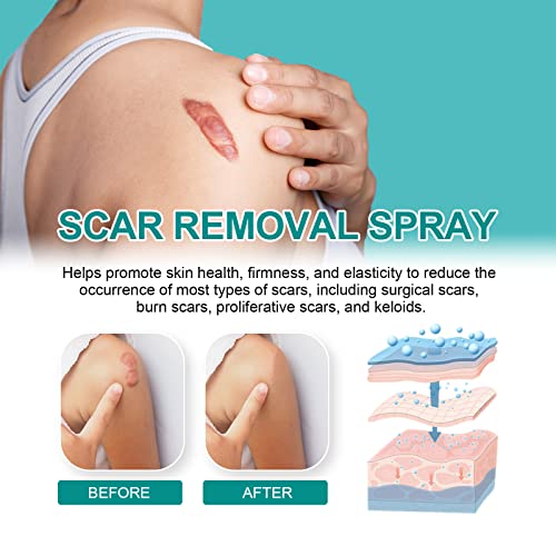 Scar Remove，Scar Remove Medical Grade Scar Spray，Etuih Scar Removal Spray，Acne Scar Treatment for Face, Acne Scars and Dark Spaot Remover, Gentle Skin Care for Acne Prone Skin (2PCS) 2pcs