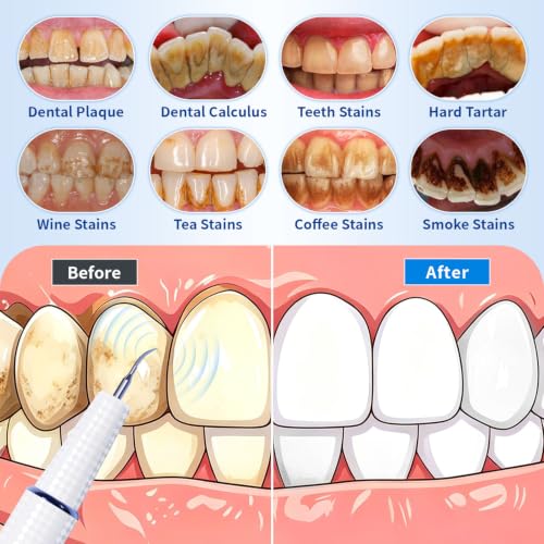 Plaque Remover for Teeth, Tartar Remover with LED Light