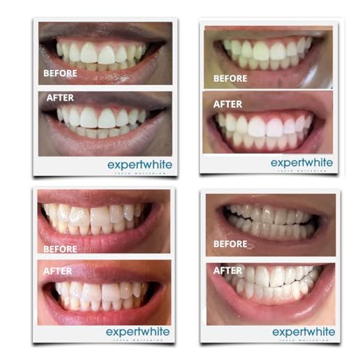16% Carbamide Peroxide Teeth Whitening Gel – Sensitive Teeth Formula – Made in USA – Professional Refill Syringes (4 x 3cc) for Use with Whitening Trays