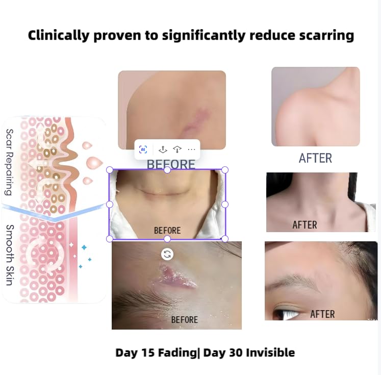 Advanced Silicone Scar Gel- Removal Cream for Old & New Scars, Effective on Acne Scars, Surgery Scars, Burn Scars, Stretch Marks, Anti Scar Gel 1.7 oz(50ml)
