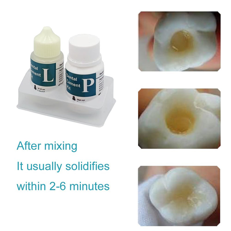 Zinc Oxide Eugenol Dental Cement Kit | Super Adhesive | Instant Tooth Repair, Cap, Crown & Bridge Filling | DIY, Self Curing, Sturdy & High Strength |Universal Shade| Emergency Dental Care |