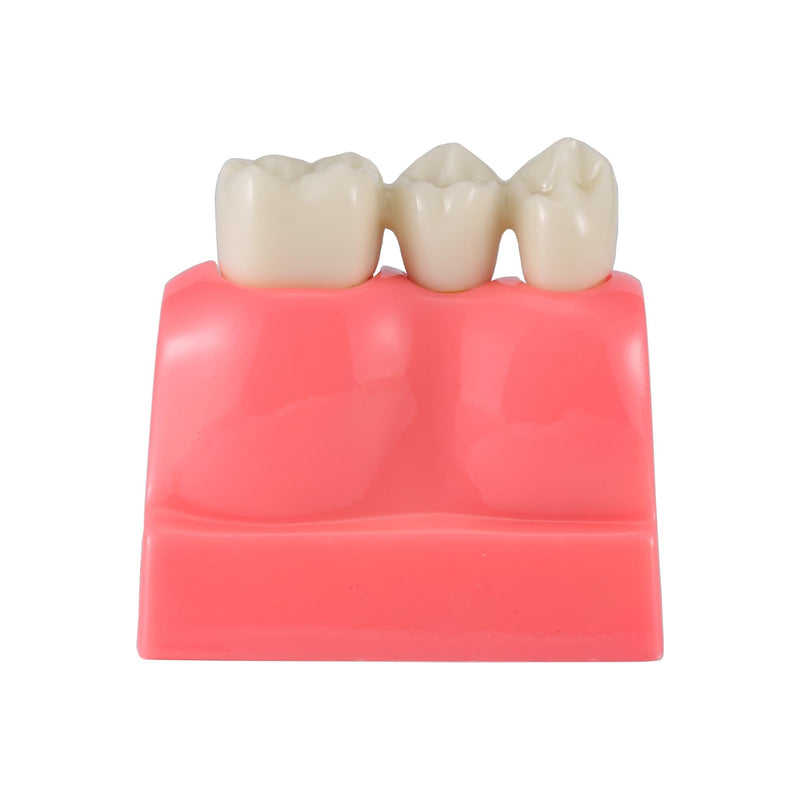 4X Dental Implant Demo Model