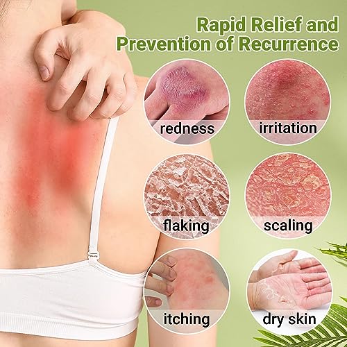 Psoriasis Cream, Maximum Strength Treatment Moisturizing Cream for Psoriasis, Dermatitis, Rash, Anti-Itch, Redness, Flaking, Scaling, Fast Acting Relief for Irritated, Dry Skin 1.76oz