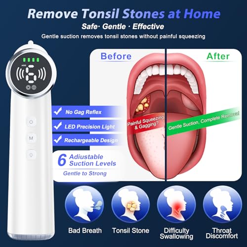 Electric Tonsil Stone Remover, 6 Suction Modes, 6-in-1 Probes & Ultra-Bright LED, Tonsil Stone Vacuum Kit with Food-Grade Silicone Tips, Painless Cleaning for Fresh Breath,Rechargeable & Waterproof M