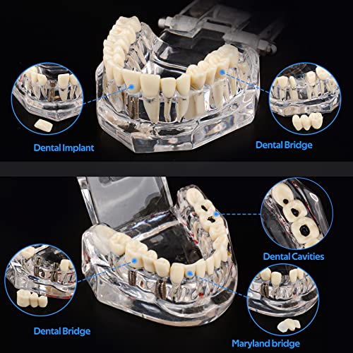 Ultrassist, Transparent Disease Teeth Model 2-Pack with Removable Teeth