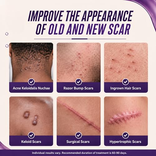ABERA Kelo Scar Cream – Scar Removal Cream for AKN Bump Treatment, Razor Bump Treatment for Men & Keloid Bump Removal with Purple Onion & Black Reishi 1 Box