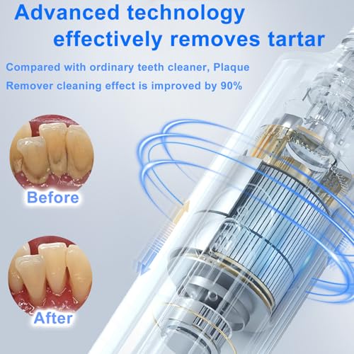 Plaque Remover for Teeth - SIQUER Teeth Cleaning Kit Dental Tools Black