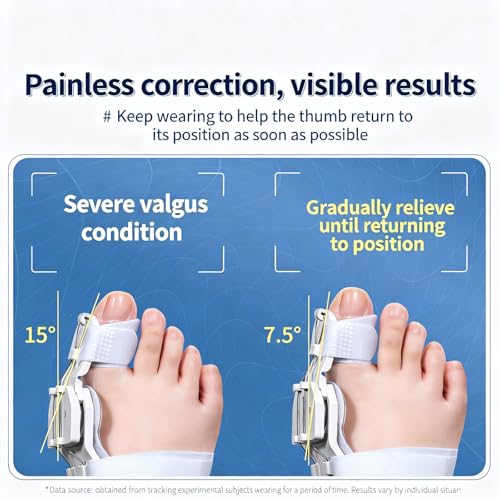 Bunion Corrector with Adjustable Knob, Big Toe Straightener Splint 1 PCS White