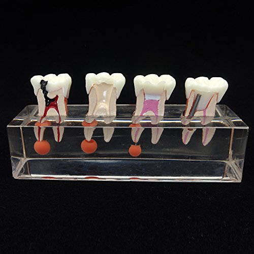 Dental Teeth Model 4-Stage Endodontic Treatment Model for Studying and Teaching …