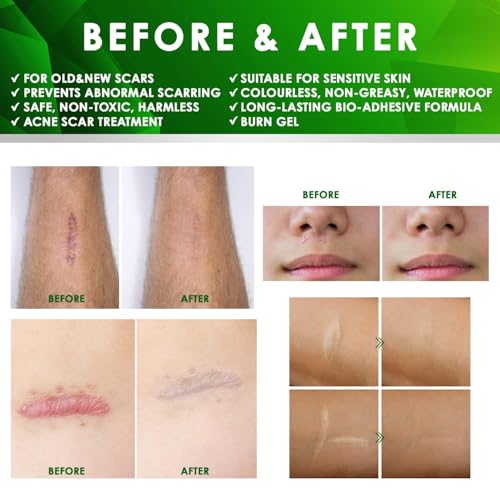 Tobcharm Advanced Keloid Bump Removal: Silicone Keloid Scar Removal Cream for Scars from Piercing, Surgical Marks, Acne, and Burns, Keloid Treatment for Ears, Face, and Body with Healing Formula 30g 1 Fl Oz (Pack of 1)