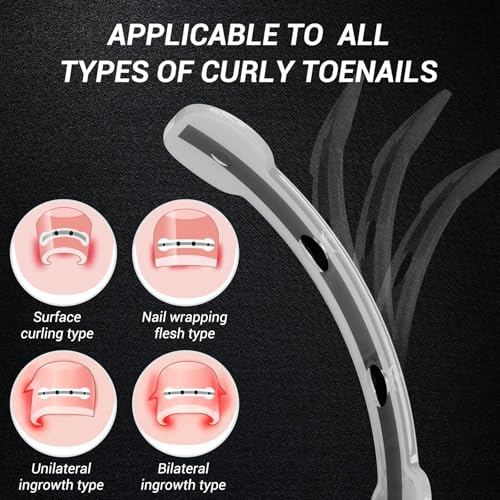 Titanium Alloy Ingrown Toenail Treatment, NailTools, and Ingrown Toenail Removal Kit SpeciallyDesigned for Curved Nail Repair and Ingrown ToenailCorrector (0.59/0.67in) 0.59/0.67in