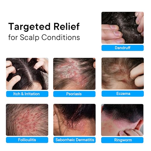 ProBliva Psoriasis Scalp Spray: Scalp Treatment for Psoriasis, Dandruff & Seborrheic Dermatitis – On-Demand Itch Relief – Helps Relieve Flaking, Scaling & Dryness – Lightweight & Non-Greasy – 4 fl.oz 1-Pack(Psoriasis Spray + 4 fl.oz Original)
