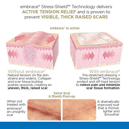 Embrace Active Scar Defense for New Scars, FDA-Cleared Medical-Grade Silicone Scar Sheets for Hypertrophic & Keloid Scar Treatment, 4.7 Inch, Large, 30-Day Supply Large, 4.7in (30 Day Supply)