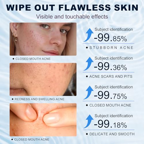 Azelaic Acid 10% Cream for Face - Acne Cream for Rosacea Reducing Relief Pimple Breakouts Blackhead Pigmentation and Redness - Azelaic Acid Gel For Facial and Skin Care