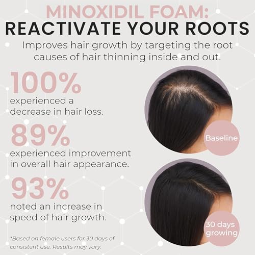Minoxidil for Women 5% Minoxidil Hair Regrowth Treatment Topical Foam