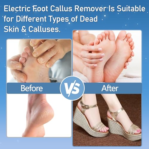 Electric Foot Callus Remover Waterproof，17 in1 Callus Remover for Feet Black