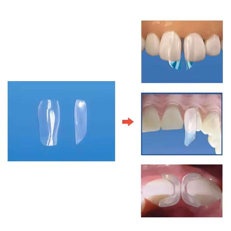 Dental Clear Matrix Anterior Matrice, BT Anterior Matrices Bioclear Style, Transparent Bow Anterior Matrices Sectional Contoured Matrix System (1, S) 1