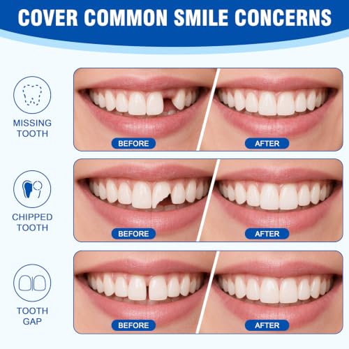 Veneers Teeth for Women and Men, Moldable Thermal Beads (White, 6PCS) White