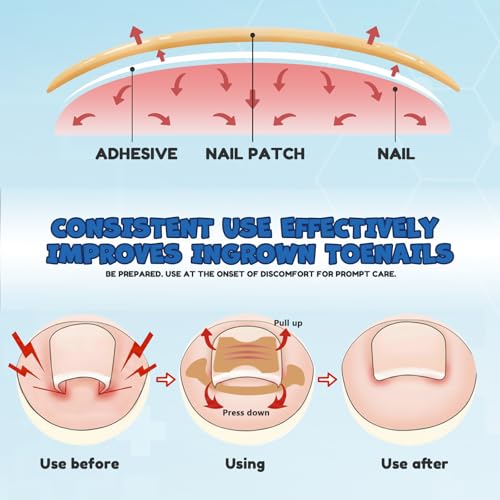 Ingrown Toenail Corrector Kit - Professional Home Pedicure Care for Toenail - Includes Toenail Correction Strips for Ingrown Toenail Relief Removal