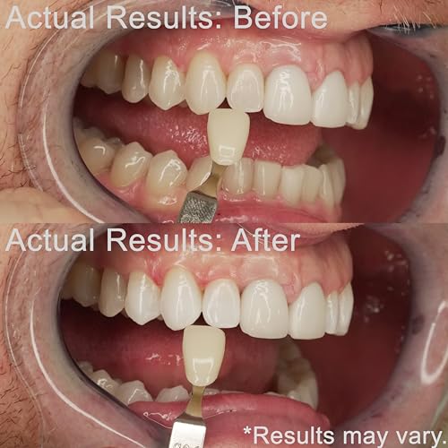 EZZI Teeth Whitening Kit | Fast Whitener Gel 44% Carbamide Peroxide | for Discolored, Yellow, Brown, Black, Coffee, Smoking, Intrinisic Deep Stains