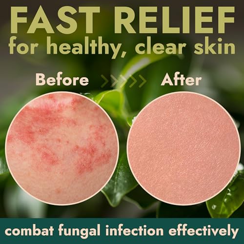 Antifungal Body Spray with Tea Tree Oil for Jock Itch & Athlete's Foot