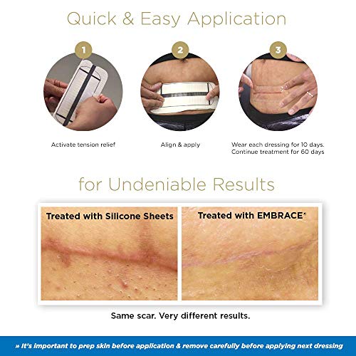 Embrace Active Scar Defense for New Scars, FDA-Cleared Medical-Grade Silicone Scar Sheets for Hypertrophic & Keloid Scar Treatment, 4.7 Inch, Large, 30-Day Supply Large, 4.7in (30 Day Supply)