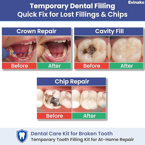 Dental Care Kit for Crowns & Bridges – Tooth Repair Kit for Loose Cap, Crown & Filling – Temporary Crown & Dental Repair Kit for At-Home Fix