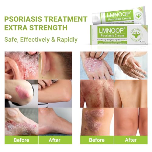 Psoriasis Cream, Maximum Strength Treatment Moisturizing Cream for Psoriasis, Dermatitis, Rash, Anti-Itch, Redness, Flaking, Scaling, Fast Acting Relief for Irritated, Dry Skin 1.76oz