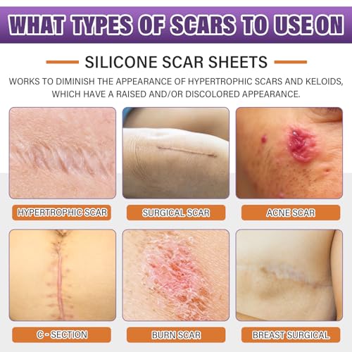 Silicone Scar Sheets, Medical Grade Silicone Scar Tape for Surgical, Hypertrophic, Keloid, C-Section, Burn, Old & New Scars, Reusable Professional Scars Removal Sheets (1.6"X 55" Roll-1.4M)