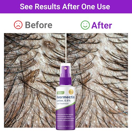 Ivermectin Lotion 0.5%, Formulated for Lice Treatment, No Head Combing Required & Just One Application Will Done, 2 oz