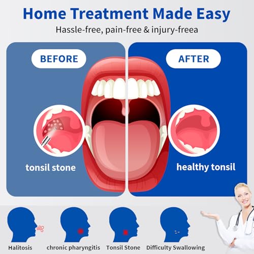 Tonsil Stone Remover with Camera，Tonsil Stone Removal Tool with LED Light，TonsilCleaner for Tonsil Stone Removal，Tonsillolith Removal Tool with 4 Head ，Attachments for iOS & Android