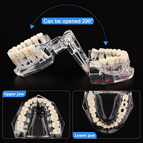 Ultrassist, Transparent Disease Teeth Model 2-Pack with Removable Teeth