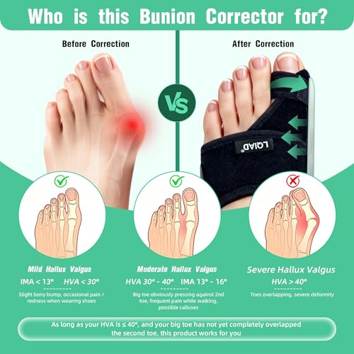 Bunion Corrector for Women & Men – Big Toe Straightener,1 Pair