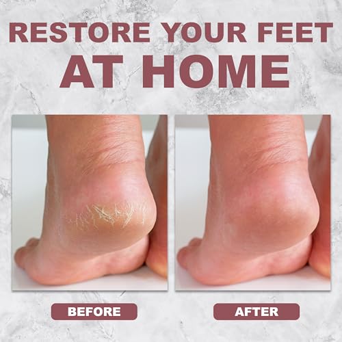 Pink Callus Remover Tool - Professional Foot File & Callus Shaver for Feet Pink