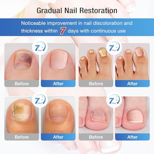 Fungal Nail Patches 60 Pcs,Upgraded Toe Nail Fungus Treatments 60 Count (Pack of 1)