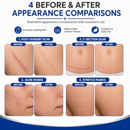 Advanced Silicone Scar Gel for Old & New Scars, C-Section & Acne, 50ML