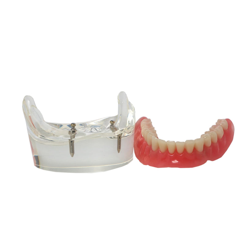 Dental Implant Model, Lower Jaw Overdenture, Removable Overdenture, with 2 Implants,M6002 M602