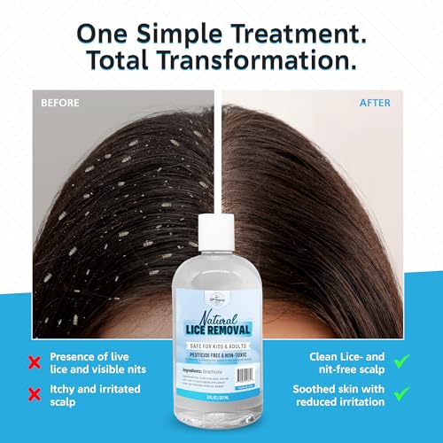 Safe Natural Lice Treatment for Kids & Adults | Gentle, Non-Irritating Lice Shampoo That Kills Eggs and Lice on All Hair Types | Dimethicone Safely Suffocates | 32oz Treats 3-5 People
